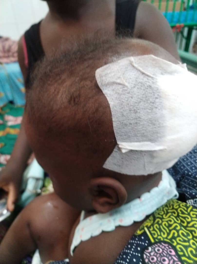 Manassé with a dressing on his head after surgery.